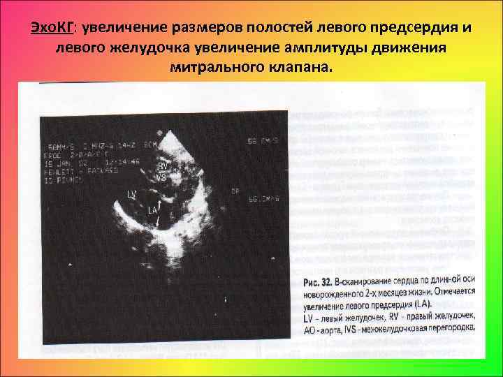 Эхо. КГ: увеличение размеров полостей левого предсердия и левого желудочка увеличение амплитуды движения митрального