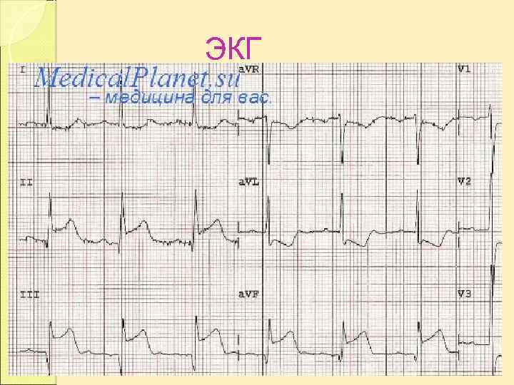 ЭКГ 