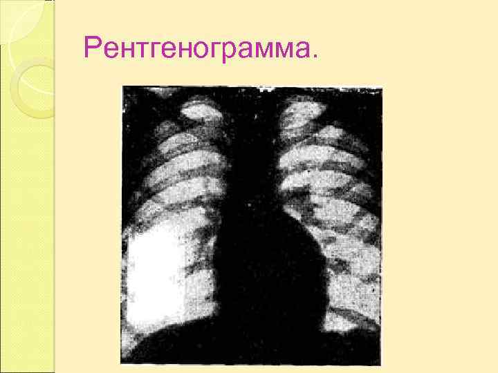 Деформация легочного рисунка по мелкоячеистому типу