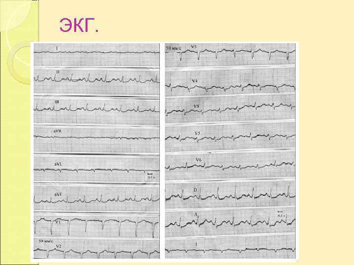 ЭКГ. 