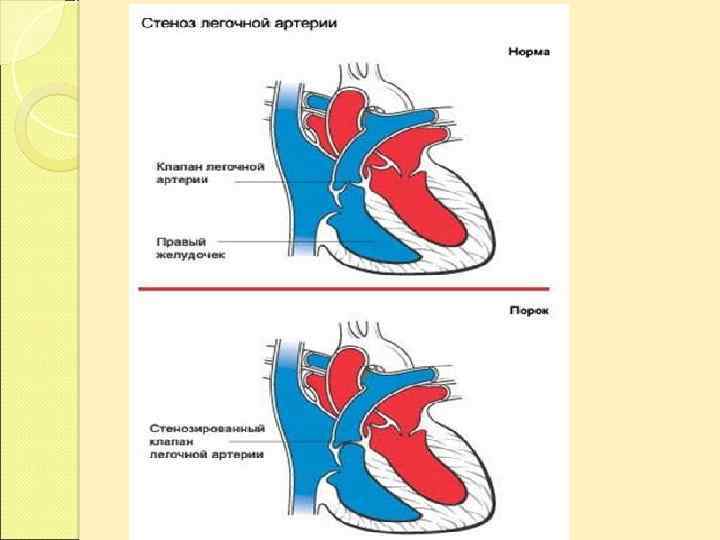 Дисфункция клапана легочной артерии