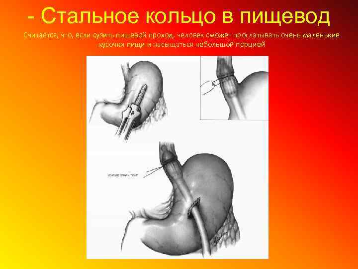 - Стальное кольцо в пищевод Считается, что, если сузить пищевой проход, человек сможет проглатывать