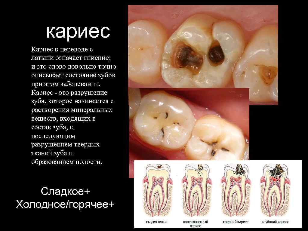 кариес Кариес в переводе с латыни означает гниение; и это слово довольно точно описывает