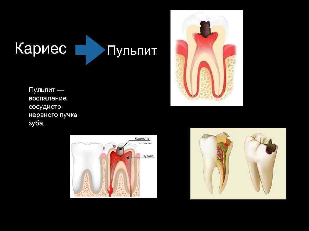 Кариес Пульпит — воспаление сосудистонервного пучка зуба. Пульпит 