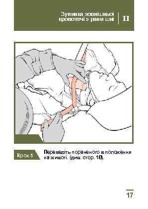 Зупинка зовнішньої кровотечі з рани шиї II Крок 4 Крок 5 Переведіть пораненого в