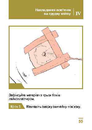 Накладання пов’язки на грудну клітку IV Крок 2 Зафіксуйте матеріал з трьох боків лейкопластиром.