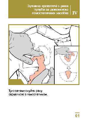 Зупинка кровотечі з рани тулуба за допомогою гемостатичних засобів IV Крок 1 Туго затампонуйте