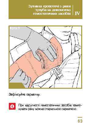 Зупинка кровотечі з рани тулуба за допомогою гемостатичних засобів IV Крок 3 Зафіксуйте серветку.