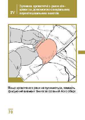 IV Зупинка кровотечі з рани кінцівки за допомогою спеціальних перев’язувальних пакетів Крок 4 Якщо
