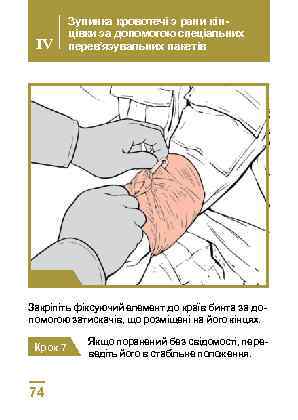 IV Зупинка кровотечі з рани кінцівки за допомогою спеціальних перев’язувальних пакетів Крок 6 Закріпіть