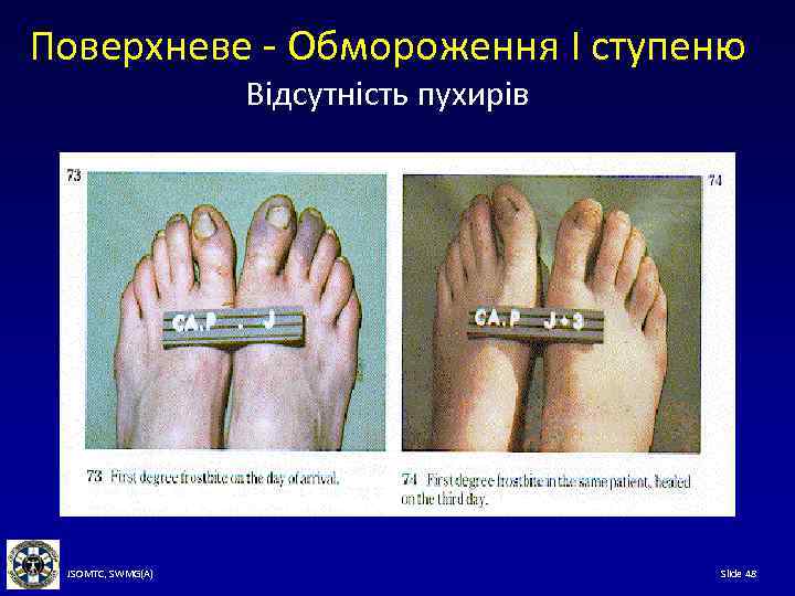 Поверхневе - Обмороження I ступеню Відсутність пухирів JSOMTC, SWMG(A) Slide 48 