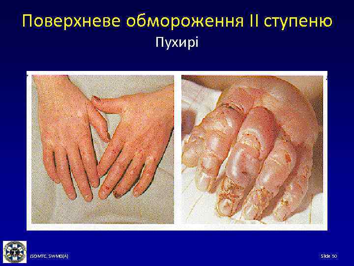 Поверхневе обмороження II ступеню Пухирі JSOMTC, SWMG(A) Slide 50 