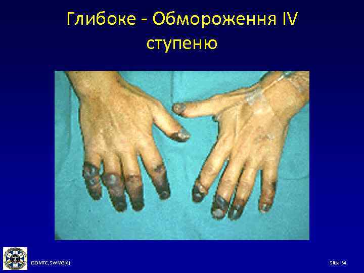 Глибоке - Обмороження IV ступеню JSOMTC, SWMG(A) Slide 54 