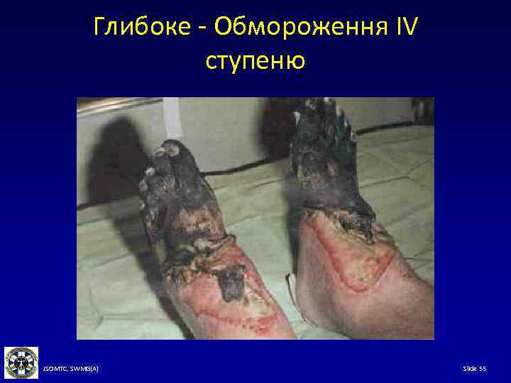 Глибоке - Обмороження IV ступеню JSOMTC, SWMG(A) Slide 55 