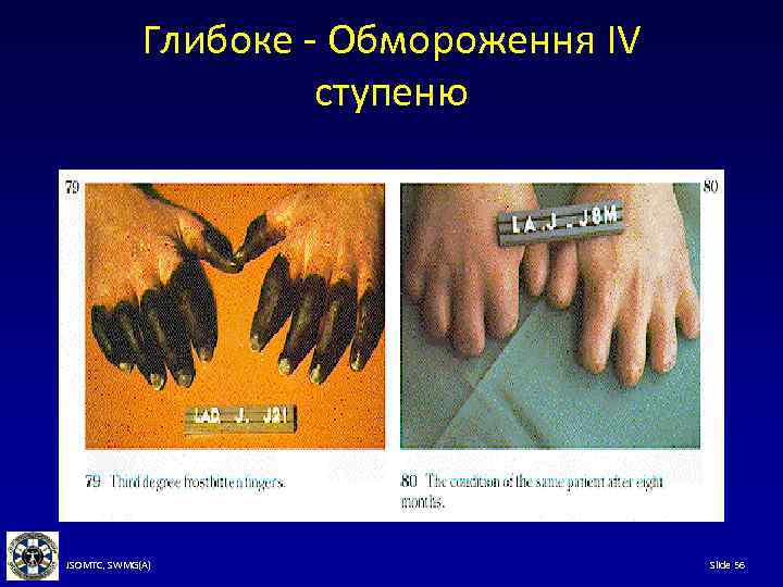 Глибоке - Обмороження IV ступеню JSOMTC, SWMG(A) Slide 56 