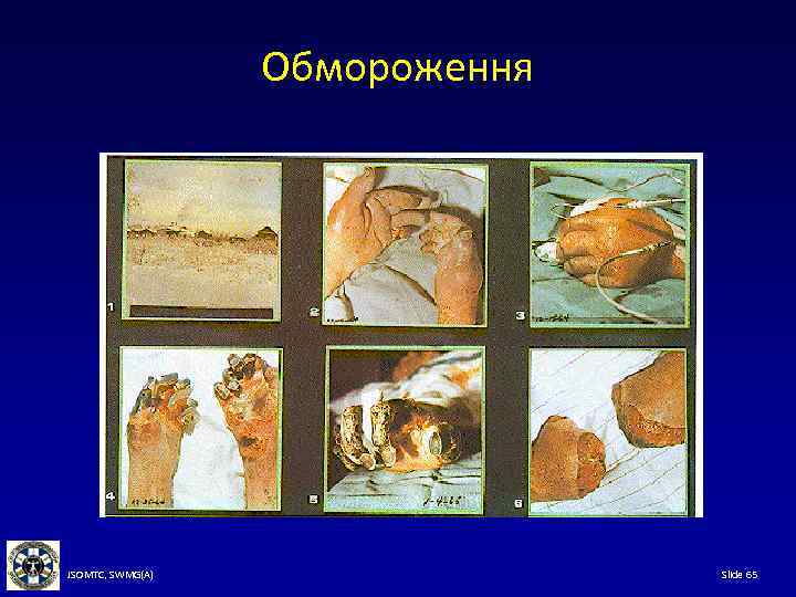 Обмороження JSOMTC, SWMG(A) Slide 65 