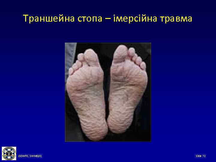 Траншейна стопа – імерсійна травма JSOMTC, SWMG(A) Slide 72 