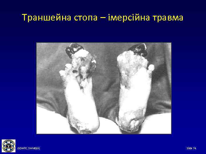 Траншейна стопа – імерсійна травма JSOMTC, SWMG(A) Slide 74 
