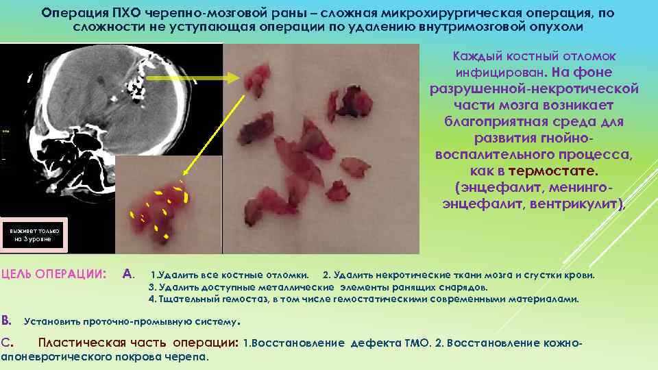 Операция ПХО черепно мозговой раны – сложная микрохирургическая операция, по сложности не уступающая операции