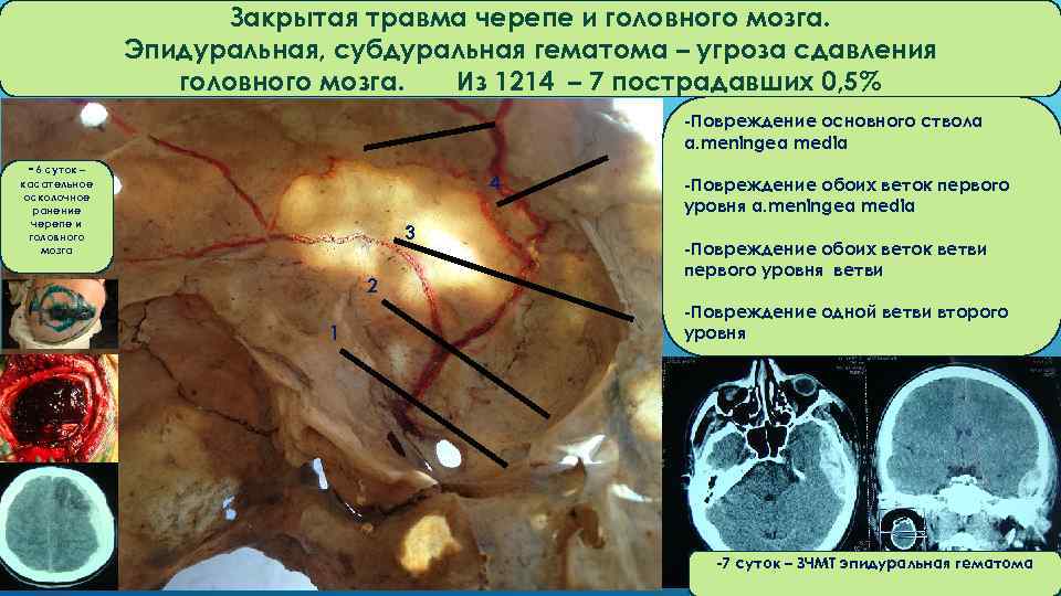 Закрытая травма черепе и головного мозга. Эпидуральная, субдуральная гематома – угроза сдавления головного мозга.