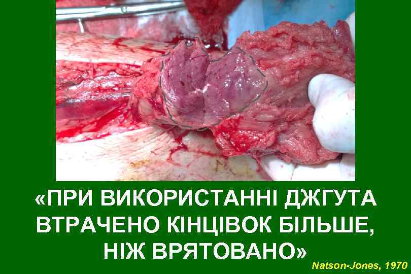  «ПРИ ВИКОРИСТАННІ ДЖГУТА ВТРАЧЕНО КІНЦІВОК БІЛЬШЕ, НІЖ ВРЯТОВАНО» Natson-Jones, 1970 