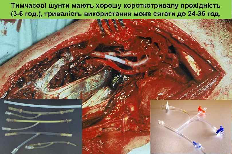 Тимчасові шунти мають хорошу короткотривалу прохідність (3 -6 год. ), тривалість використання може сягати