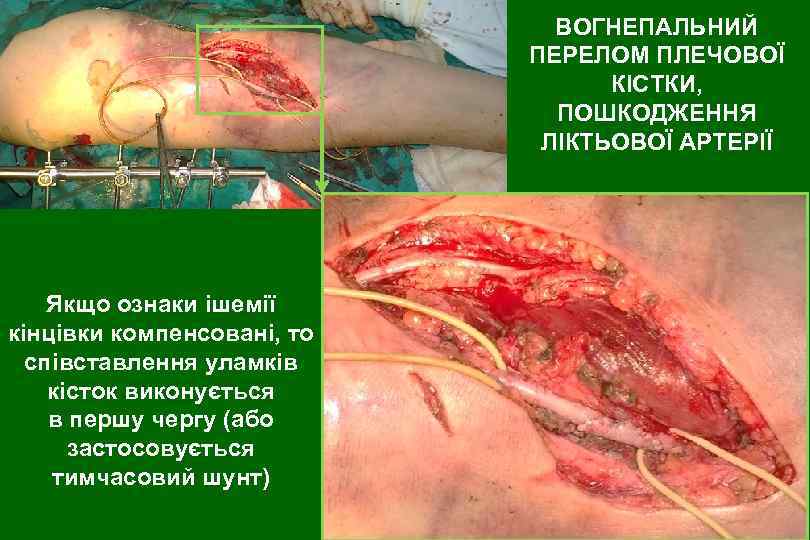 ВОГНЕПАЛЬНИЙ ПЕРЕЛОМ ПЛЕЧОВОЇ КІСТКИ, ПОШКОДЖЕННЯ ЛІКТЬОВОЇ АРТЕРІЇ Якщо ознаки ішемії кінцівки компенсовані, то співставлення