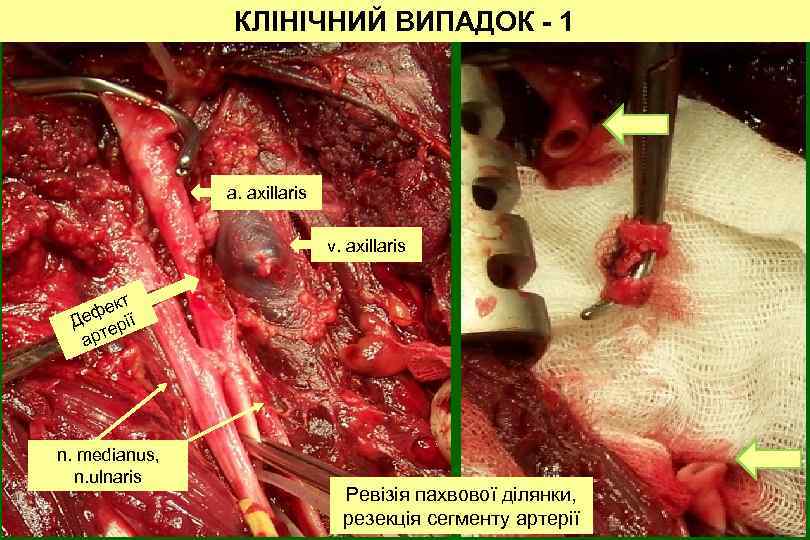 КЛІНІЧНИЙ ВИПАДОК - 1 a. axillaris v. axillaris ект Деф ерії арт n. medianus,