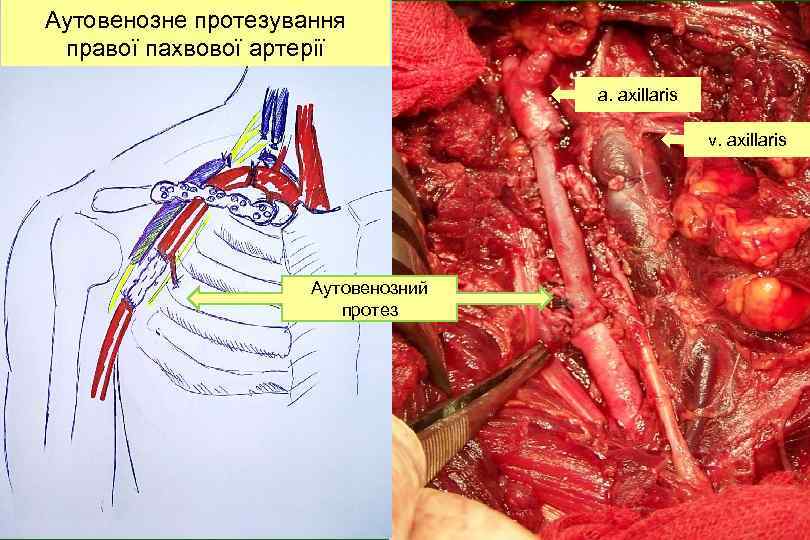 Аутовенозне протезування правої пахвової артерії a. axillaris v. axillaris Аутовенозний протез 