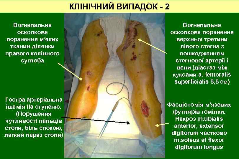 КЛІНІЧНИЙ ВИПАДОК - 2 Вогнепальне осколкове поранення м′яких тканин ділянки правого колінного суглоба Гостра