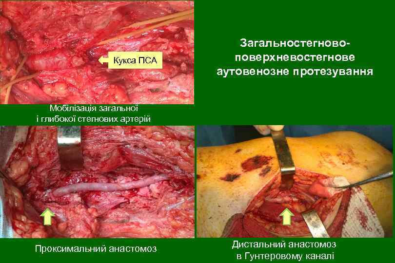 Кукса ПСА Загальностегновоповерхневостегнове аутовенозне протезування Мобілізація загальної і глибокої стегнових артерій Проксимальний анастомоз Дистальний