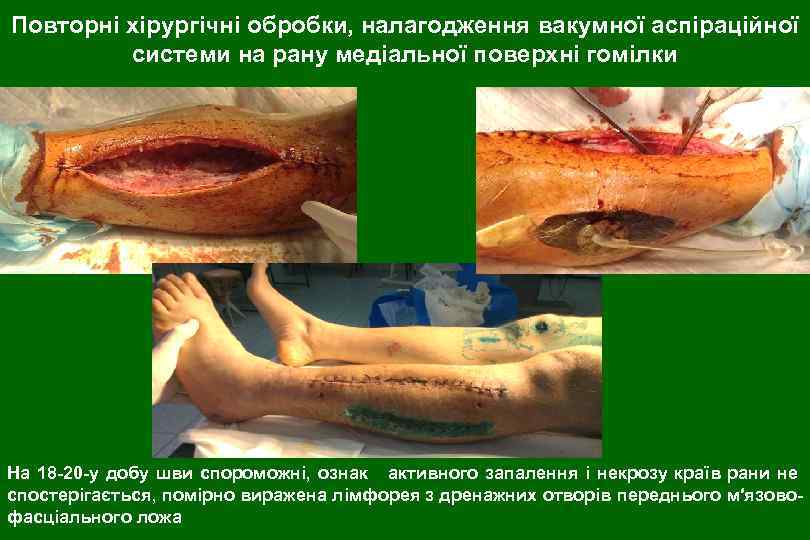 Повторні хірургічні обробки, налагодження вакумної аспіраційної системи на рану медіальної поверхні гомілки На 18