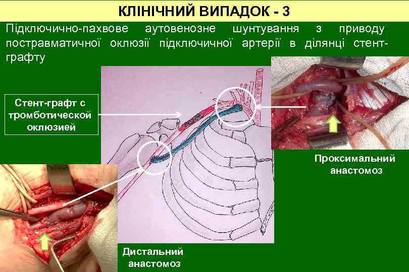 КЛІНІЧНИЙ ВИПАДОК - 3 Підключично-пахвове аутовенозне шунтування з приводу постравматичної оклюзії підключичної артерії в