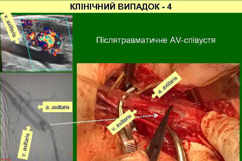 КЛІНІЧНИЙ ВИПАДОК - 4 v. a ris xilla Післятравматичне AV-співустя is x r lla