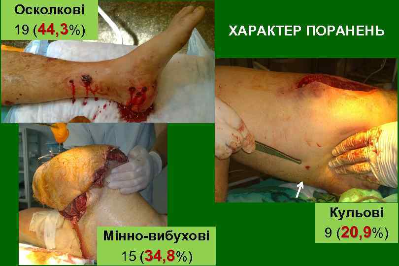 Осколкові 19 (44, 3%) ХАРАКТЕР ПОРАНЕНЬ Мінно-вибухові 15 (34, 8%) Кульові 9 (20, 9%)