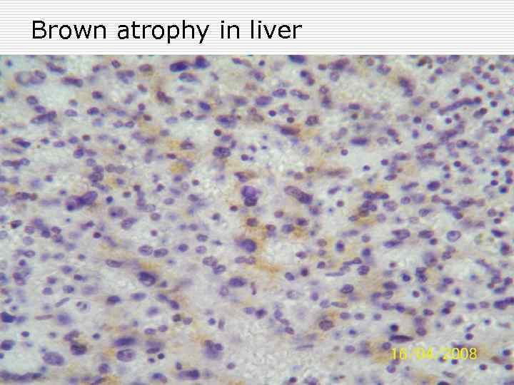 Brown atrophy in liver 