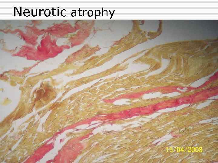 Neurotic atrophy 