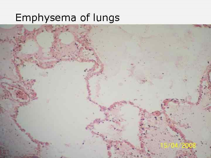 Emphysema of lungs 