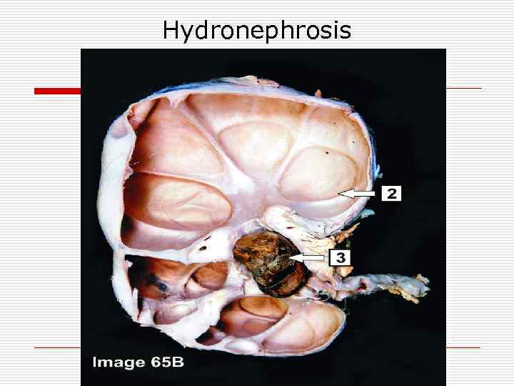 Hydronephrosis 