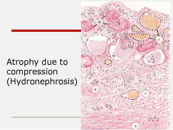 Аtrophy due to compression (Hydronephrosis) 