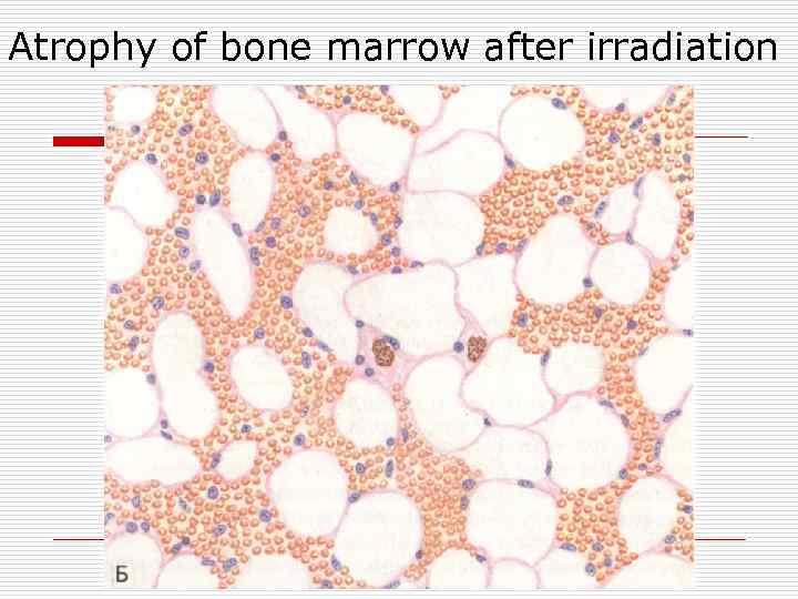 Аtrophy of bone marrow after irradiation 