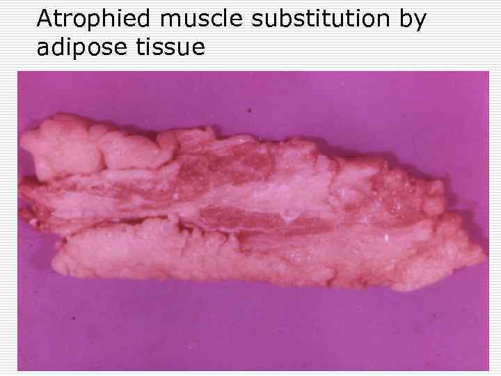 Atrophied muscle substitution by adipose tissue 