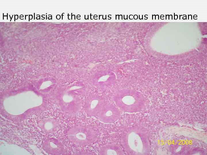 Hyperplasia of the uterus mucous membrane 