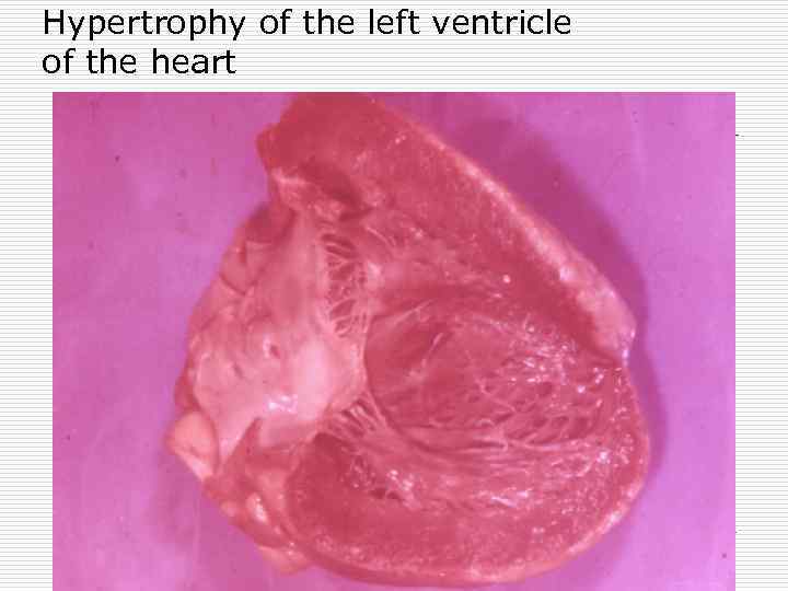 Hypertrophy of the left ventricle of the heart 