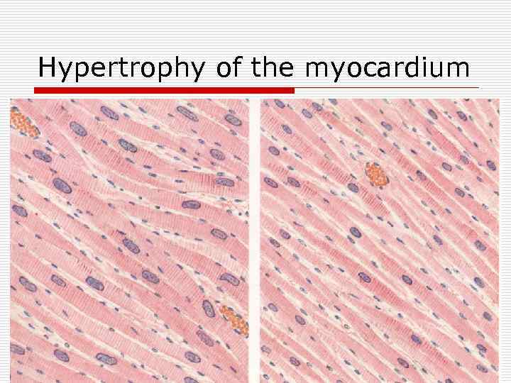 Hypertrophy of the myocardium 