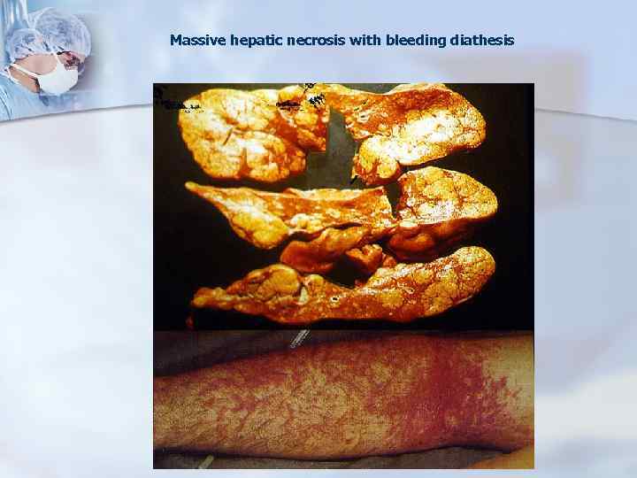 Massive hepatic necrosis with bleeding diathesis 