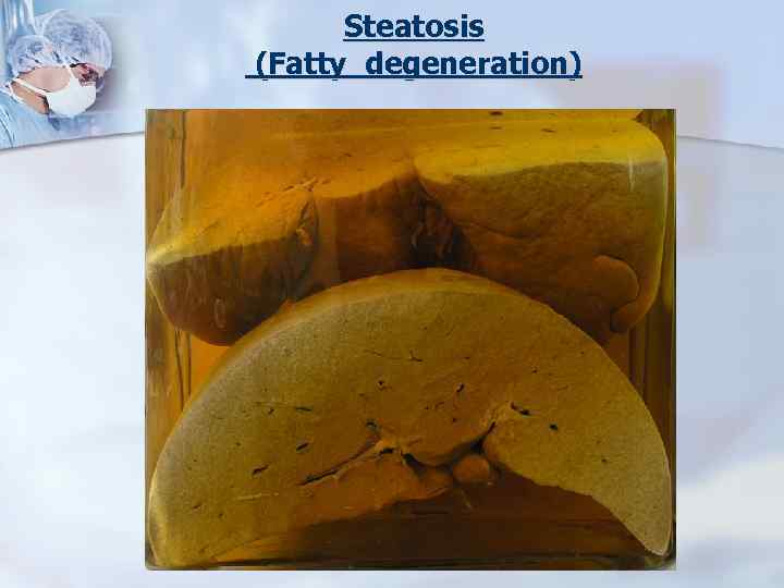 Steatosis (Fatty degeneration) 