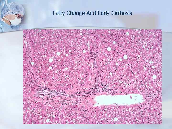 Fatty Change And Early Cirrhosis 