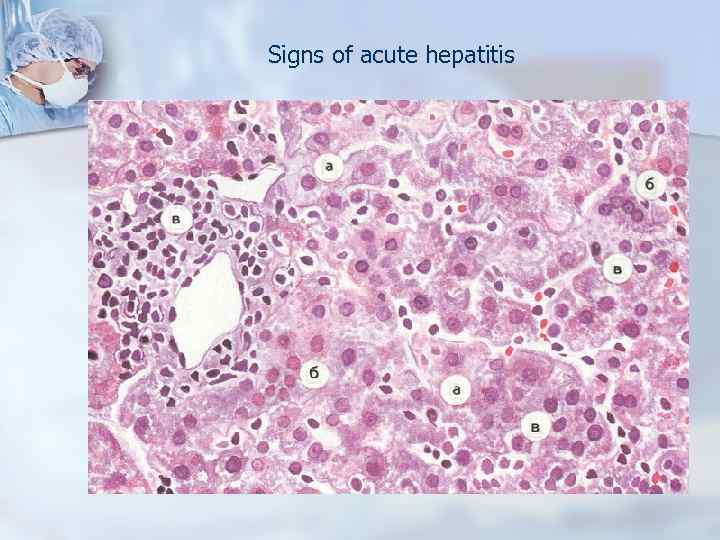 Signs of acute hepatitis 