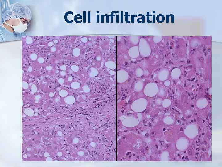 Cell infiltration 